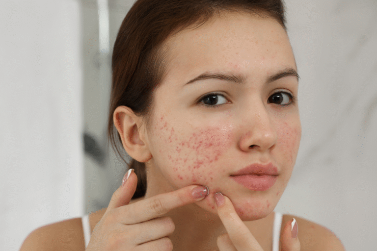 Myths and Facts About Acne