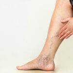 Treating Varicose Veins